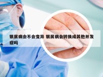 银屑病会不会变异 银屑病会转换成其他并发症吗