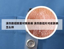 清热散结胶囊对银屑病 清热散结片对皮肤病怎么样