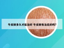 牛皮鲜多久才能治好 牛皮鲜有治愈的吗?