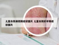 儿童白斑病初期症状图片 儿童白斑的早期症状图片