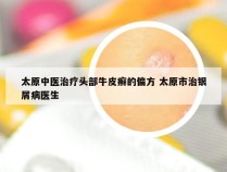 太原中医治疗头部牛皮癣的偏方 太原市治银屑病医生