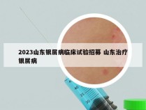 2023山东银屑病临床试验招募 山东治疗银屑病