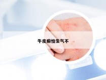 牛皮癣怕生气不