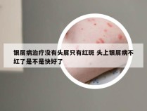 银屑病治疗没有头屑只有红斑 头上银屑病不红了是不是快好了
