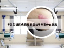 寻常型银屑病基因 银屑病寻常型什么意思