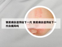 银屑病会遗传给下一代 银屑病会遗传给下一代白癜风吗