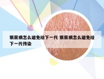 银屑病怎么避免给下一代 银屑病怎么避免给下一代传染