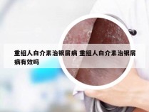 重组人白介素治银屑病 重组人白介素治银屑病有效吗