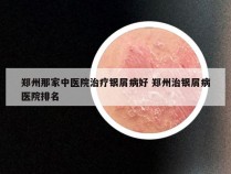 郑州那家中医院治疗银屑病好 郑州治银屑病医院排名