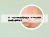 2023治疗银屑病新进展 2023治疗银屑病新进展视频
