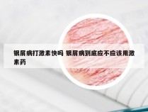 银屑病打激素快吗 银屑病到底应不应该用激素药