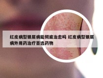 红皮病型银屑病能彻底治愈吗 红皮病型银屑病外用药治疗首选药物