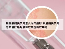 银屑病的关节炎怎么治疗最好 银屑病关节炎怎么治疗最好最有效中医有效果吗