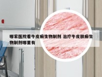 哪家医院看牛皮癣生物制剂 治疗牛皮肤癣生物制剂哪里有