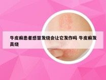 牛皮癣患者感冒发烧会让它发作吗 牛皮癣发高烧