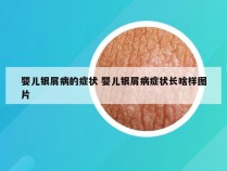 婴儿银屑病的症状 婴儿银屑病症状长啥样图片