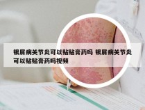 银屑病关节炎可以贴贴膏药吗 银屑病关节炎可以贴贴膏药吗视频