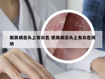 银屑病舌头上有白色 银屑病舌头上有白色斑块