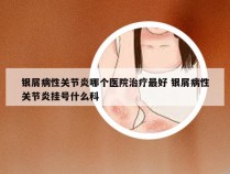 银屑病性关节炎哪个医院治疗最好 银屑病性关节炎挂号什么科