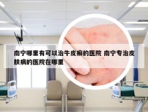 南宁哪里有可以治牛皮癣的医院 南宁专治皮肤病的医院在哪里