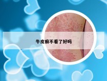 牛皮癣不看了好吗