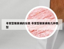 寻常型银屑病的分类 寻常型银屑病有几种类型
