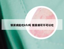 银屑病能吃kfc吗 银屑病可不可以吃