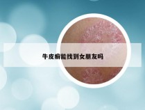 牛皮癣能找到女朋友吗