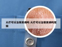 火疗可以治银屑病吗 火疗可以治银屑病吗视频
