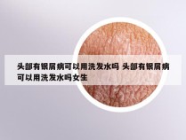 头部有银屑病可以用洗发水吗 头部有银屑病可以用洗发水吗女生