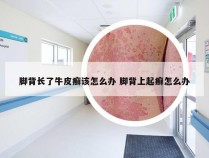 脚背长了牛皮癣该怎么办 脚背上起癣怎么办