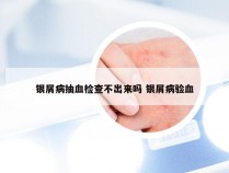 银屑病抽血检查不出来吗 银屑病验血