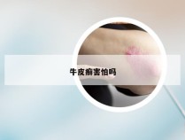 牛皮癣害怕吗