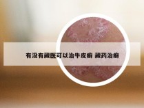 有没有藏医可以治牛皮癣 藏药治癣