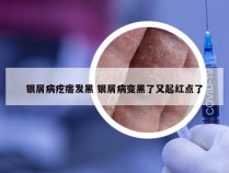 银屑病疙瘩发黑 银屑病变黑了又起红点了