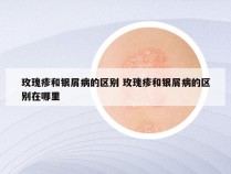 玫瑰疹和银屑病的区别 玫瑰疹和银屑病的区别在哪里
