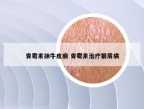 青霉素抹牛皮癣 青霉素治疗银屑病