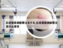红皮银屑病都要注意什么 红皮银屑病都要注意什么事项