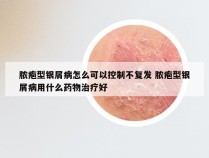 脓疱型银屑病怎么可以控制不复发 脓疱型银屑病用什么药物治疗好
