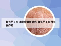 曲克芦丁可以治疗银屑病吗 曲克芦丁有没有副作用