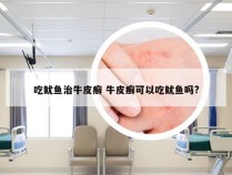 吃鱿鱼治牛皮癣 牛皮癣可以吃鱿鱼吗?
