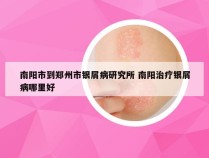 南阳市到郑州市银屑病研究所 南阳治疗银屑病哪里好