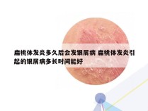 扁桃体发炎多久后会发银屑病 扁桃体发炎引起的银屑病多长时间能好
