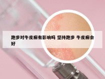 跑步对牛皮癣有影响吗 坚持跑步 牛皮癣会好