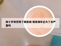 四十岁突然得了银屑病 银屑病年纪大了会严重吗