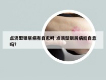 点滴型银屑病有自愈吗 点滴型银屑病能自愈吗?
