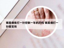 银屑病有打一针控制一年的药吗 银屑病打一针就见效