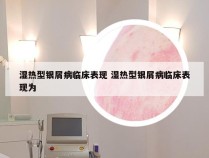 湿热型银屑病临床表现 湿热型银屑病临床表现为