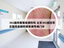 301医院看银屑病性吗 北京301解放军总医院皮肤科银屑病专病门诊