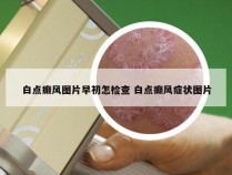 白点癫风图片早初怎检查 白点癫风症状图片